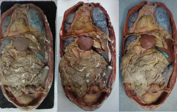 situs inversus